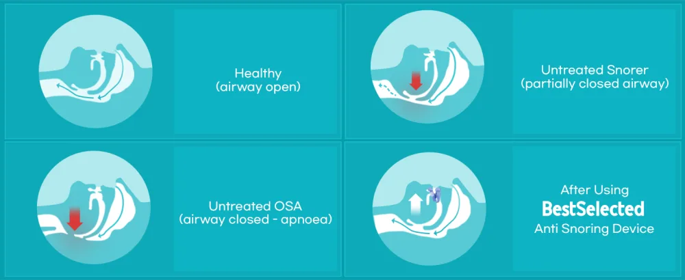 Anti Snoring Mouth Guard Device: Medium Anti Snoring Devices Ronflement Solution - Stop Snore Guard Mouthpiece Sleeping Mouth Stopper - Sleep Apnea Devices (Blue) - Anti Snoring Devices