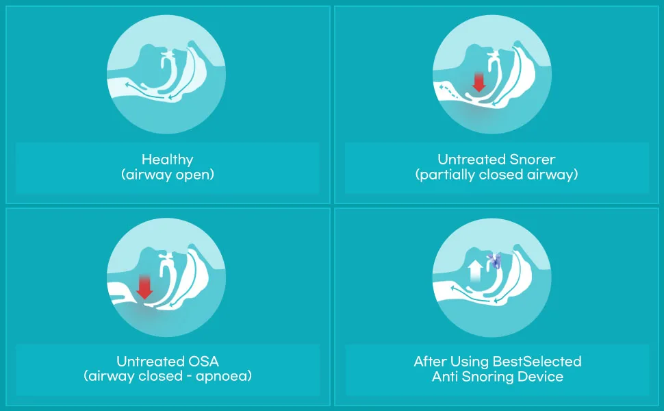 Anti Snoring Mouth Guard Device: Medium Anti Snoring Devices Ronflement Solution - Stop Snore Guard Mouthpiece Sleeping Mouth Stopper - Sleep Apnea Devices (Blue) - Anti Snoring Devices for Men and Women