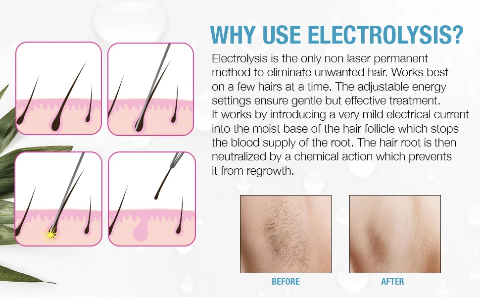 Clean + Easy Non-Laser Personal Electrolysis Device - Permanent Hair Removal for Face and Body, Battery Operated, Painless and Convenient Home Treatment - Clean + Easy Non-Laser Electrolysis Replacement Tips for Face & Body, 2-Pack