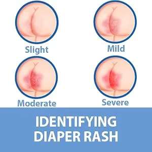 Caldesene Medicated Protecting Powder, Cornstarch & Zinc Oxide, Talc Free, 5oz - Identifying diaper rash