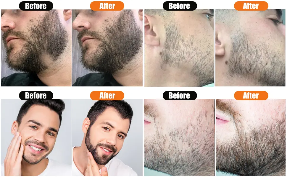 Beard Derma Roller Microneedle Roller for Beard Growth, 0.25mm Derma Roller for Patchy Beard Growth Black - BG04