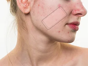 AUSLKA Blemish Patch Hydrocolloid Blemishes Patch Dots for Face Zit Patches Zit Stickers (9 Patches) 9 count (Pack of 1) - blemish patches