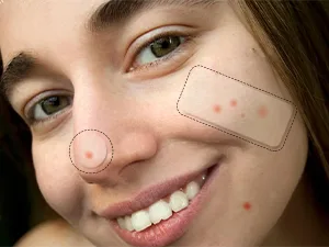 AUSLKA Blemish Patch Hydrocolloid Blemishes Patch Dots for Face Zit Patches Zit Stickers (9 Patches) 9 count (Pack of 1) - blemish patches