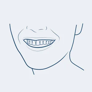 Auraglow  Teeth Whitening Pen, 35% Carbamide Peroxide, 20+ Whitening Treatments, No Sensitivity, 2.8mL - smile