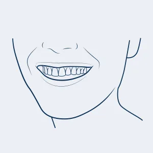 Auraglow Teeth Whitening Gel Refill Pack, 35% Carbamide Peroxide, 30 Whitening Treatments, (3) 10mL Whitening Gel Syringes - white smile