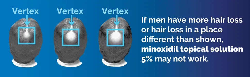 Basic Care Minoxidil Topical Solution USP, 5 Percent, Hair Regrowth Treatment for Men, Extra Strength, 2 Fl Oz (Pack of 6) - hair loss vertex image