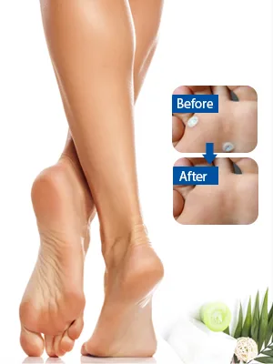 TXL Active Feet Corn Remover, Toe Corn Remover, 30 Pack, Remove Corns Fast, One Step Corn Removers for Feet and Toe, Cushioning Protection Against Shoe Pressure, 30 Pack - corn