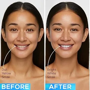GLO Science GLO Brilliant 3 Pack Teeth Whitening Gel Treatment Kit for Fast, Pain-Free, Long Lasting Results - before and after