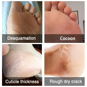 ALIVER Exfoliating Foot Peel Mask Dead Skin Callus Remover - Aloe Vera - Pack of 3 - mask