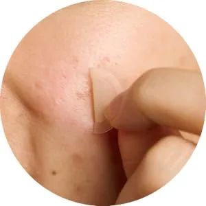 Mighty Patch Micropoint for Dark Spots from Hero Cosmetics - Post-Blemish Dark Spot Patch with 395 Micropoints, Dermatologist Tested and Non-irritating, Not Tested on Animals (8 Count) 8 Patches - Brighten up