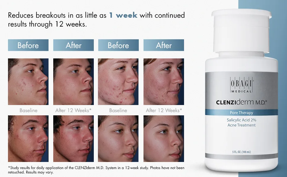 Obagi Medical CLENZIderm M.D. Pore Therapy Acne Treatment 5 Fl Oz (Pack of 1) - before using & after