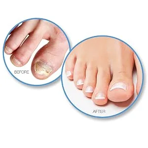 Barielle Fungus Rx 1 ounce - Before & After 1