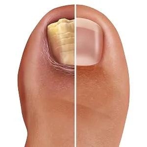 Barielle Fungus Rx 1 ounce - Before & After 2