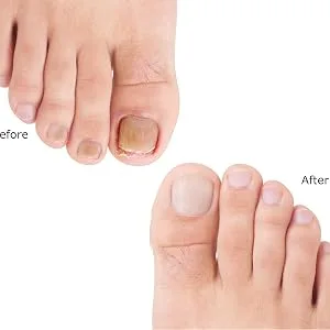 Barielle Fungus Rx 1 ounce - Before & After 3
