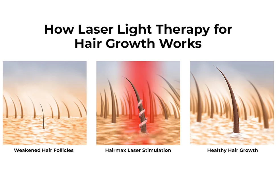 Bundled HairMax Treatment for Hair Growth includes LaserBand 41 (FDA Cleared) for Full Scalp Hair Loss with a combination of Density 3pc Bio-Active Hair Therapy System and Hair Dietary Supplements - How laser light therapy works with Hairmax LaserBand 41