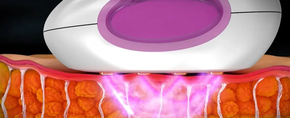 Silkn Silhouette Body Contouring and Cellulite Reduction Device with LED Light Therapy - Silk