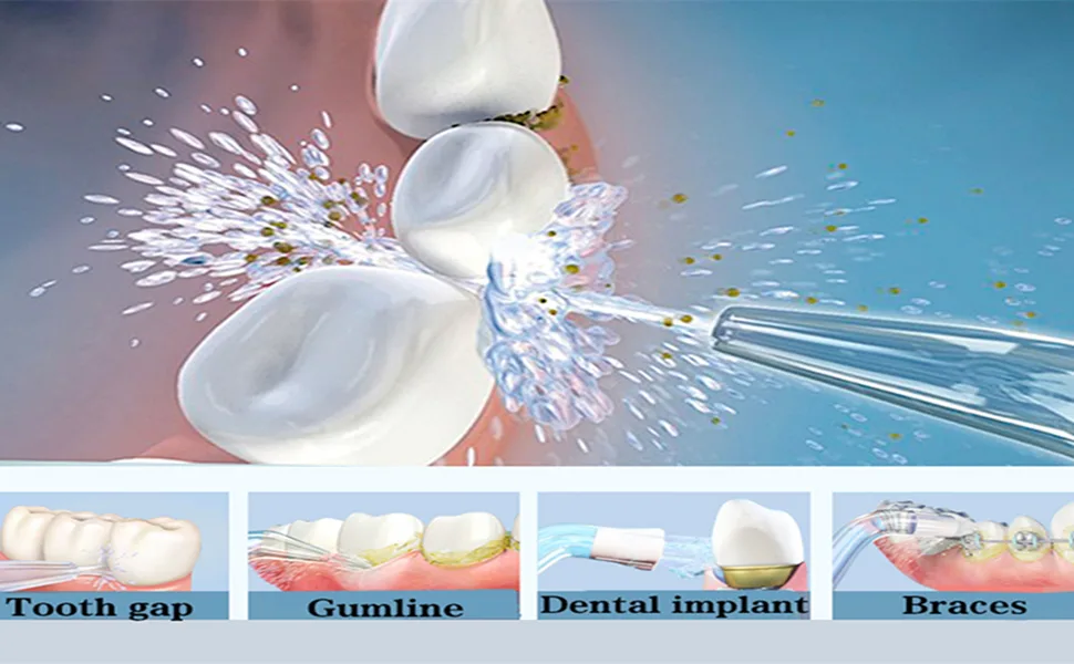 WuYan 4pcs Replacement Classic Jet Tips High Pressure for Flosser WP-70 WP-60 - product information 10