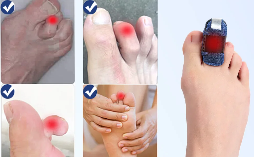 1 Pair Toe Splint for Broken Toe, Hammer Toe Straightener Toe Corrector, Toe Brace for Big Toe, Curled Toe, Women Men Broken Toe to Align and Support Toe Wraps, Extended Adjustable Strap - Toe brace mainly corrects and straightens your toe