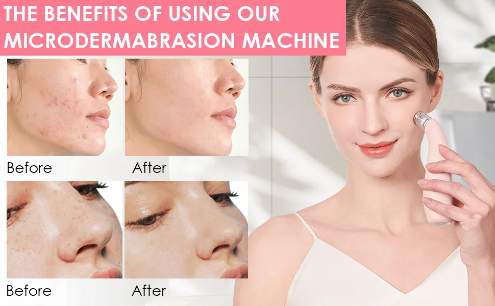 NEWDERMO 2-in-1 Microdermabrasion Machine for Facial, Diamond Microdermabrasion Device USB Rechargeable - Advanced Home Facial Treatment Machine (Pink) - BENEFITS
