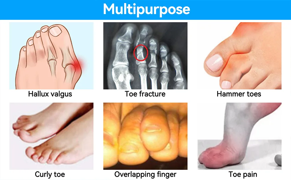 Toe Brace, Multi Adhesive Toe Fracture Fixator, Hallux Valgus Correction Splints, Toe Protectors Support Brace for Men Women(Black) - product information 2