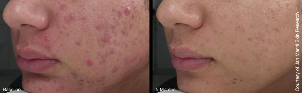 Jan Marini Skin Research Age Intervention Duality | Acne and Anti-Aging Solution -1 oz. - product information 1