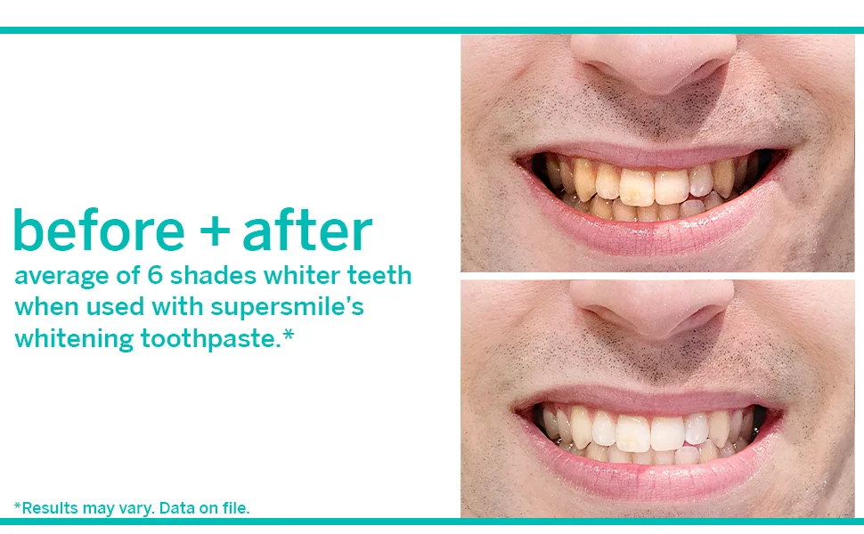 Supersmile Professional Whitening Accelerator - Powerful Whitening without Sensitivity - Safe and Effective on Dental Restorations (3.6 Oz) - before and after supersmile whitening system