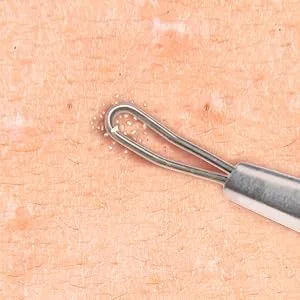 Beaute Galleria Double Loop Blackhead Remover Pimple Extractor Popper for Acne Comedone Blemish Whitehead Zit Removal Tool - Beaute Galleria Double Loop Blackhead Remover Pimple Extractor Acne Comedone Blemish Removal Tool