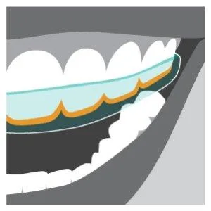 DenTek Comfort Fit Dental Guard Kit - product information 3
