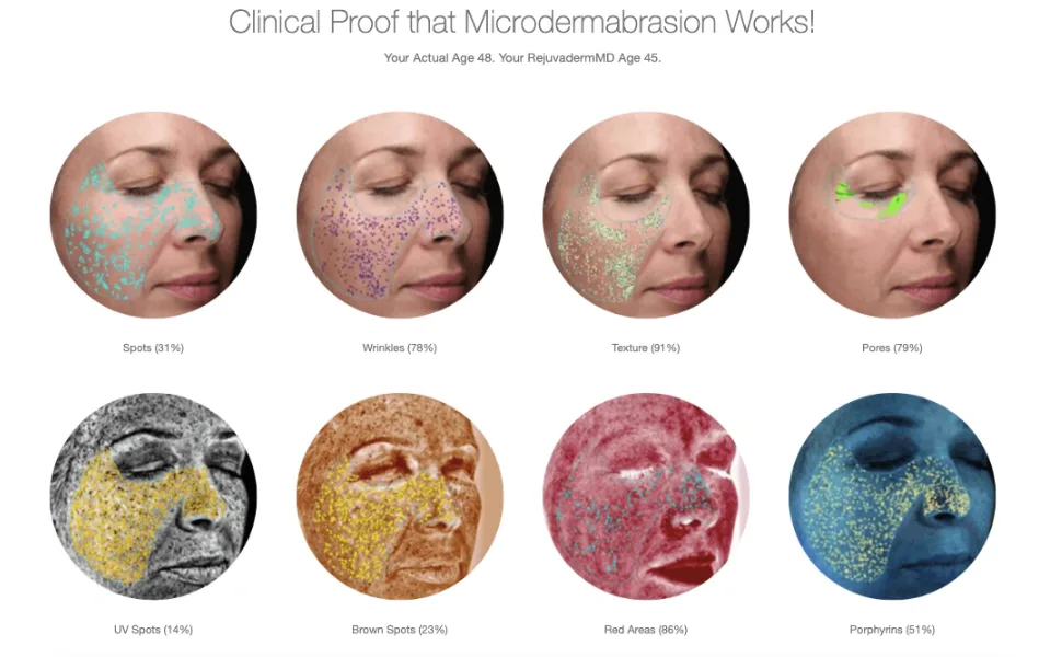 Trophy Skin MiniMD - Mini Handheld Microdermabrasion System - Improves Texture and Skin Tone - Clinical proof that MiniMD microdermabrasion by trophy skin works