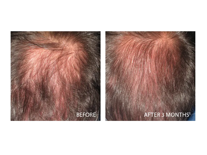 Ducray Neoptide Men Hair Lotion  0.32 lb. - Ducray Before & After