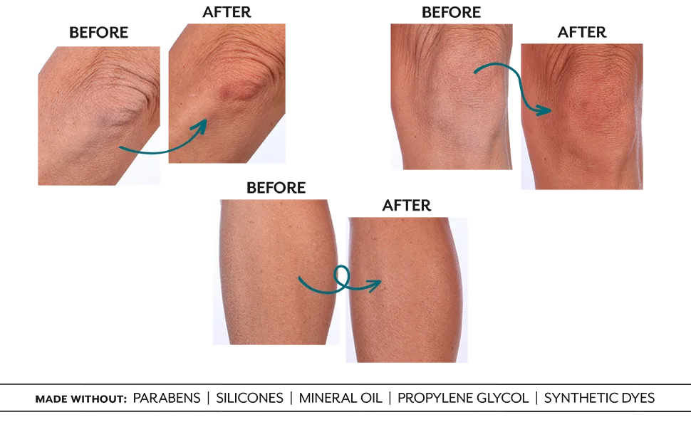 Lavido - Natural Thera Intensive Body Cream | Replenish  Nourish + Protect Dry  Sensitive Skin (8.45 oz | 250 ml) - Before + After 6 weeks using Lavido