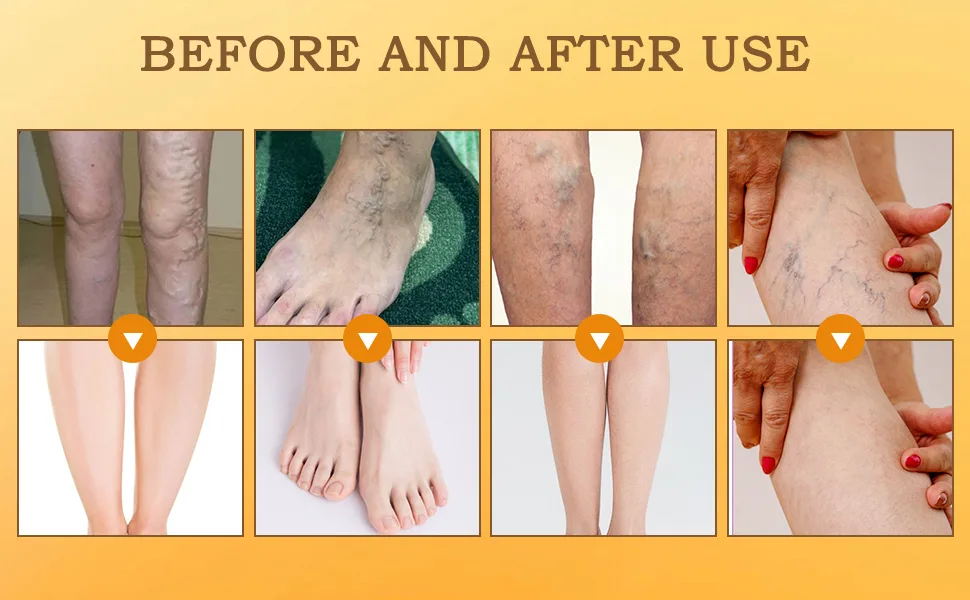 Wanban 48 PCS Turmeric Varicose Vein Patch Natural Relief Treatment for Legs Spider Varicose Vein Patch - 48 PCS Turmeric Varicose Vein Patch