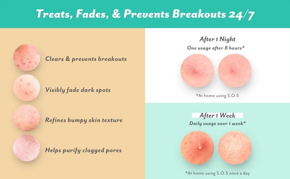 Patchology S.O.S. Overnight Acne Solution Gel-to-Patch Clarifying Liquid Patch 2.9% Sulfur 3% Niacinamide Dries Clear Fast Results Makeup Safe Pregnancy Safe Face & Body Use - Mussum Ipsum