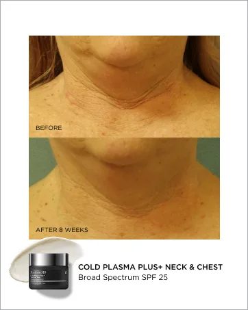 Perricone MD Hypoallergenic Clean Correction Rebalancing Elixir 4 fl. oz. - Brand Story Frame 5: Cold Plasma Plus+ Neck &amp; Chest B&amp;A