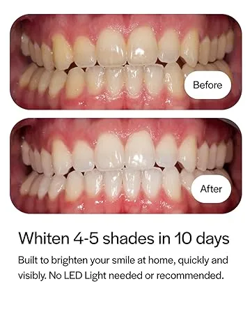 Opalescence Toothpaste 4.7oz Original Whitening Formula Dental Health Care - Before &amp; After 10 Days