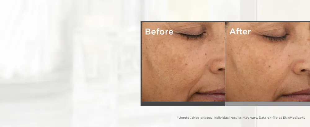 SkinMedica Lumivive Day & Night System Set   2 Piece Set - before and after