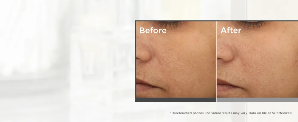 SkinMedica Lumivive Day & Night System Set   2 Piece Set - before and after