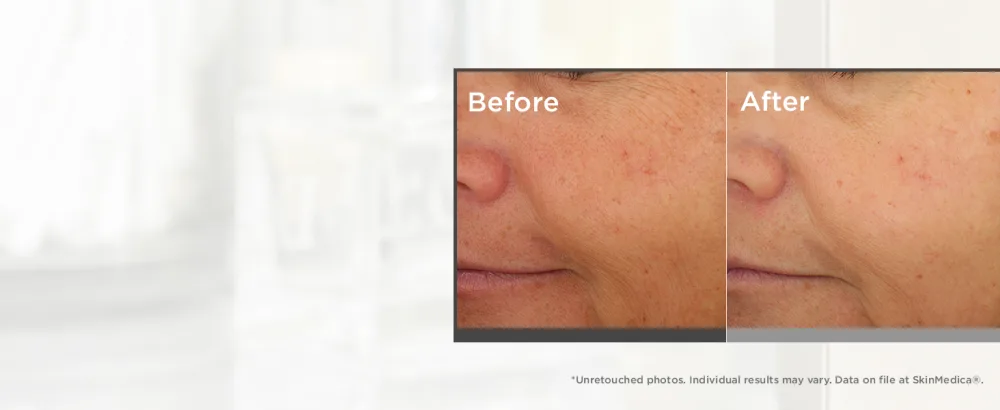 SkinMedica Lumivive Day & Night System Set   2 Piece Set - before and after
