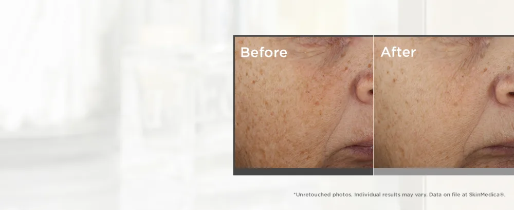 SkinMedica Lumivive Day & Night System Set   2 Piece Set - before and after