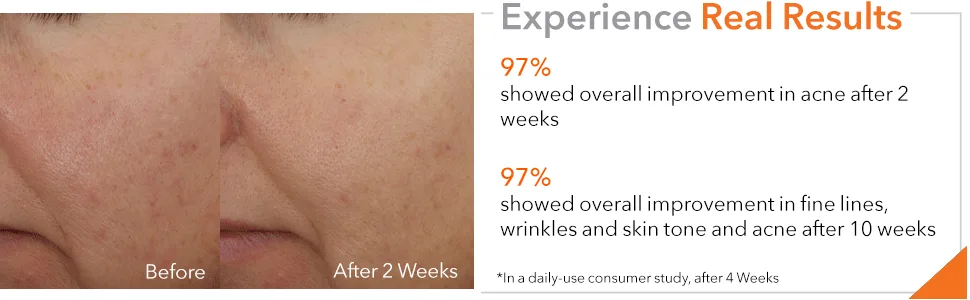 Dr. Dennis Gross DRx Acne Eliminating Pads: for Acne  Oily Skin  Clogged Pores  and Inflammation  (45 Treatments) - DRx Acne Eliminating Pads 45