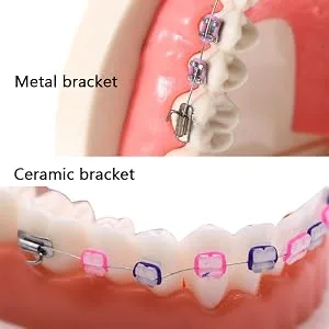 Angzhili 1 Piece Dental Demonstration Orthodontic Model with Metal Wires and Bracket (Metal bracket) - product information 3