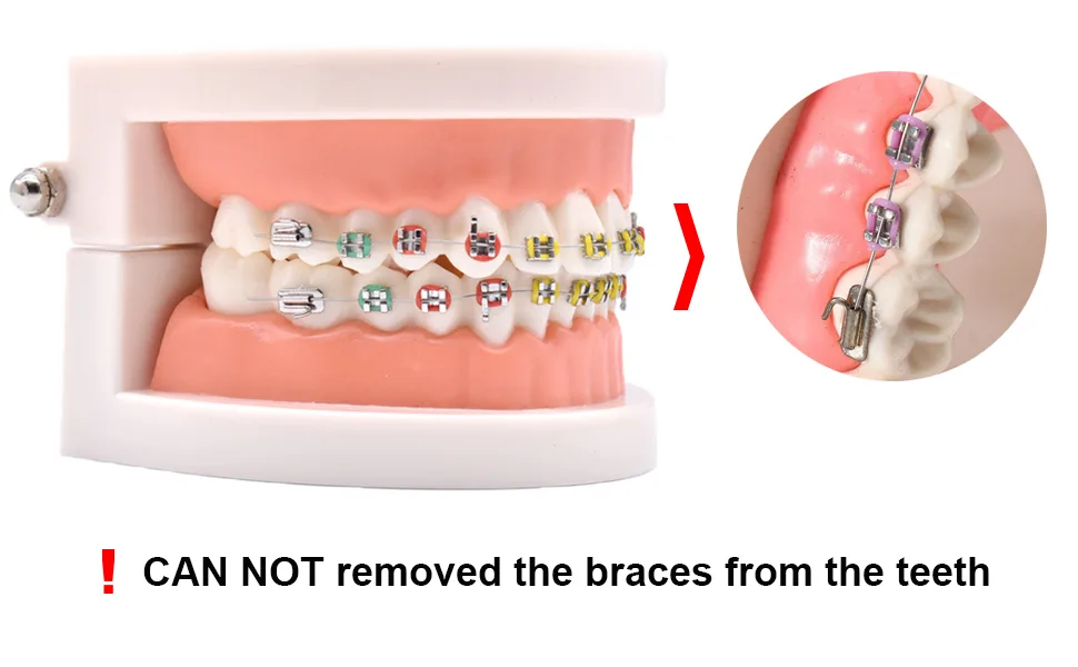Angzhili 1 Piece Dental Demonstration Orthodontic Model with Metal Wires and Bracket (Metal bracket) - Visual Model Tool