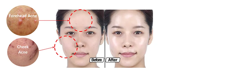 DERMALOGY by NEOGENLAB A-CLEAR SOOTHING ACNE CARE Soothing Foam Cleanser - product information 9