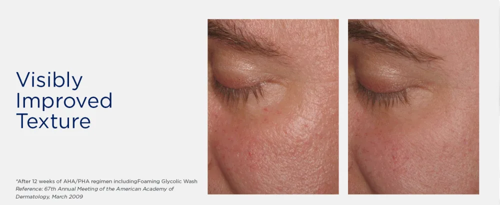 NEOSTRATA Foaming Glycolic Face Wash High Strength AHA Cleanser Soap-free  4.2 fl. oz. - Before & After