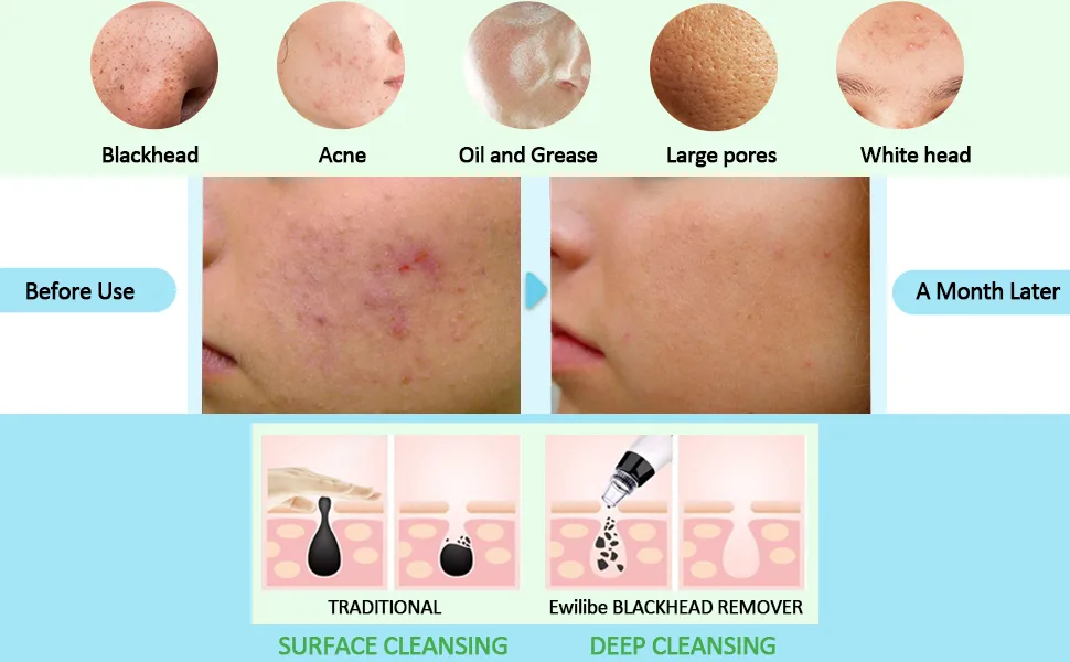 Blackhead Remover Vacuum Pore Cleaner - Acne Comedone Extractor Whitehead Tool Exfoliating Machine Removal Beauty IPL with 5 Adjustable Suction Power and 5 Replacement Probes LED USB Rechargeable - Blackhead Remover Vacuum Pore Cleaner Acne Comedone Extractor Exfoliating Machine Removal Beauty
