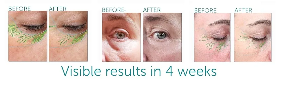 FACTORFIVE Eye and Lash Cream with Human Derived Apidose Stem Cell Growth Factors for Anti Aging  Crows Feet Reduction  and Under-Eye Bags 0.16fl oz/5ml - eye/lash cream before and after results and scans