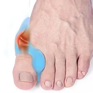SMATIS Bunion Correctors Toe Straightener  4PCS Light Blue Bunion Protector Toe Separators Gel Big Toe for Hallux Valgus Relieve Pain - Bunion correctors