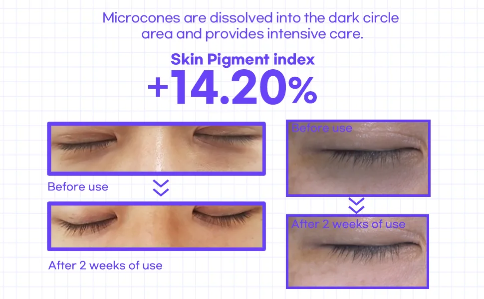  Acropass UNDER EYE CARE microcone patch | Decreases the Appearance of Dark Circles and Eye Bags | Microcone patch | Under Eye Patch | Eye Patch - Clinical result of dark circle
