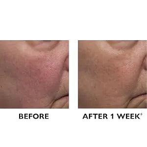 Peter Thomas Roth | Vital-E Microbiome Age Defense Cream 1.7 Oz - Peter Thomas Roth, Vital-E Microbiome Age Defense Cream, before and after, B&A