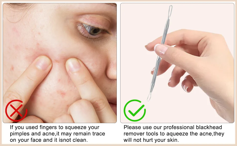 Professional Blackhead Remover Blemish Extractor Tool - Pimple Comedone Removal 2-In-1 Stainless Steel Pimple Popper(2pcs) - acne tool
